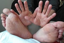 Bệnh tay chân miệng gia tăng phức tạp - Cách phòng tránh và điều trị bệnh